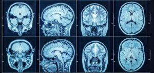 brain cancer awareness